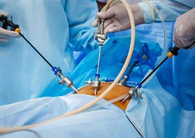 Beneficios de la cirugia de vesicula laparoscopica