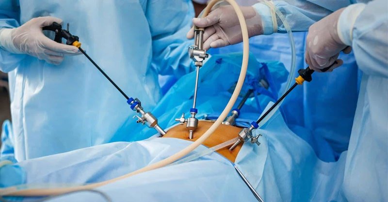 Beneficios de la cirugia de vesicula laparoscopica